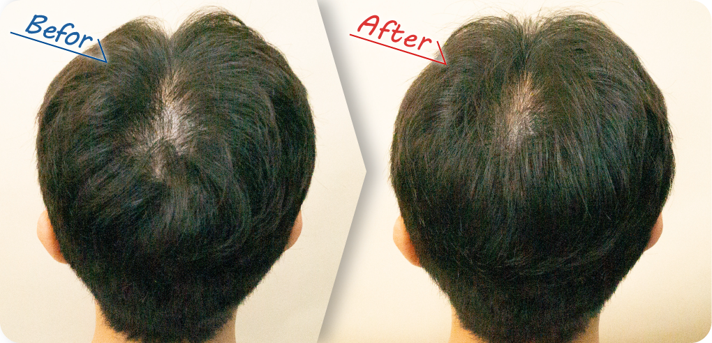 ビフォーアフター頭頂部300本